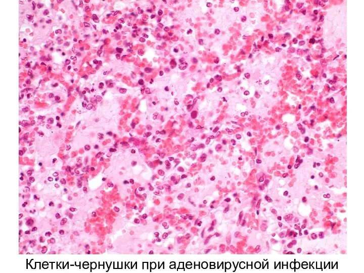 Клетки-чернушки при аденовирусной инфекции