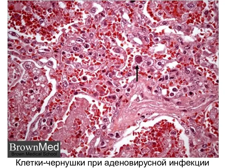 Клетки-чернушки при аденовирусной инфекции