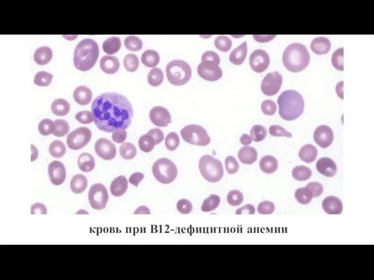 кровь при B12-дефицитной анемии