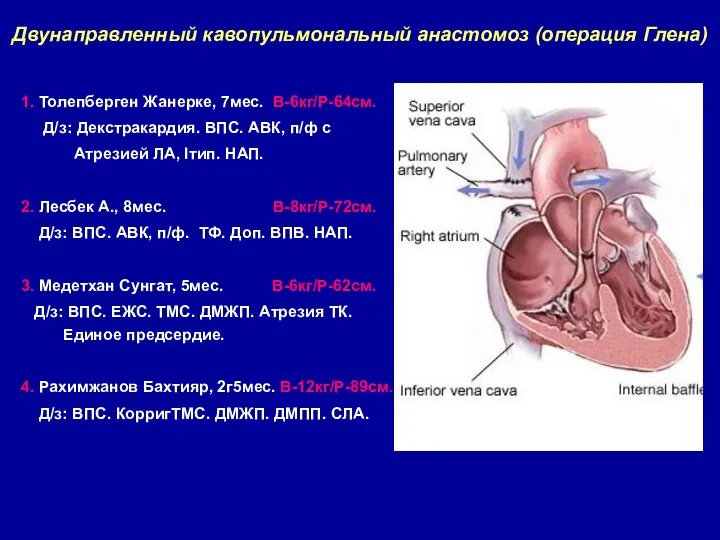 Двунаправленный кавопульмональный анастомоз (операция Глена)