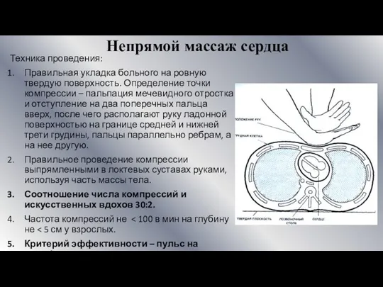 Непрямой массаж сердца Техника проведения: Правильная укладка больного на ровную твердую поверхность.