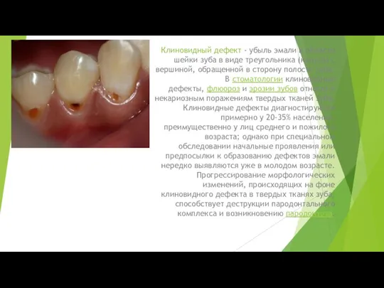 Клиновидный дефект - убыль эмали в области шейки зуба в виде треугольника