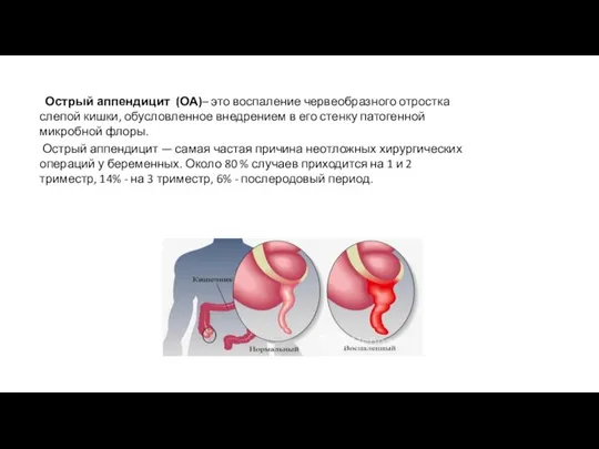 Острый аппендицит (ОА)– это воспаление червеобразного отростка слепой кишки, обусловленное внедрением в