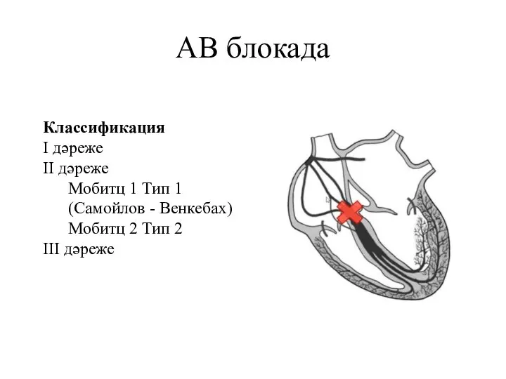 АВ блокада Классификация I дәреже II дәреже Мобитц 1 Тип 1 (Самойлов