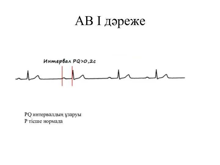 АВ I дәреже PQ интервалдың ұзаруы Р тісше нормада