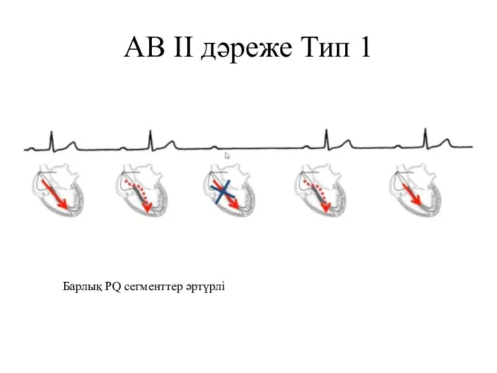 АВ II дәреже Тип 1 Барлық PQ сегменттер әртүрлі