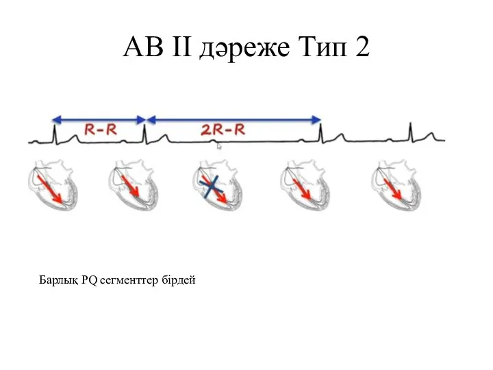 АВ II дәреже Тип 2 Барлық PQ сегменттер бірдей