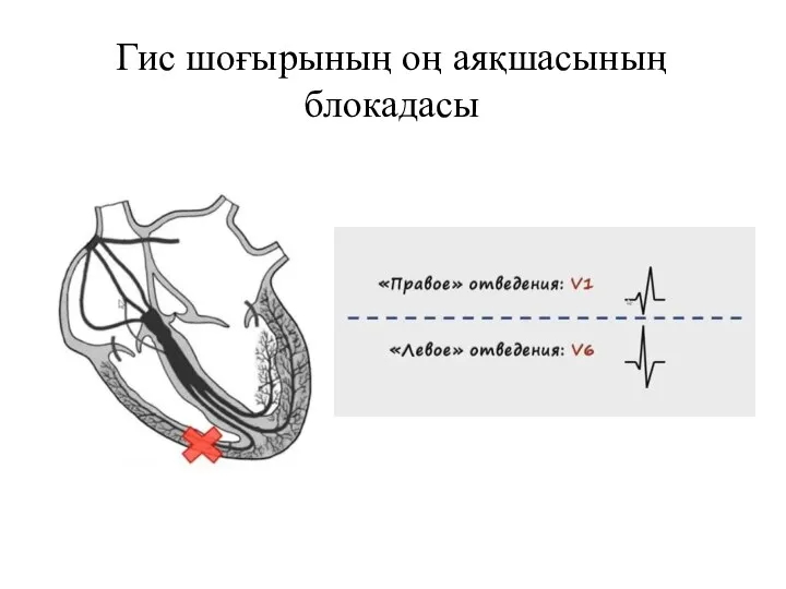 Гис шоғырының оң аяқшасының блокадасы