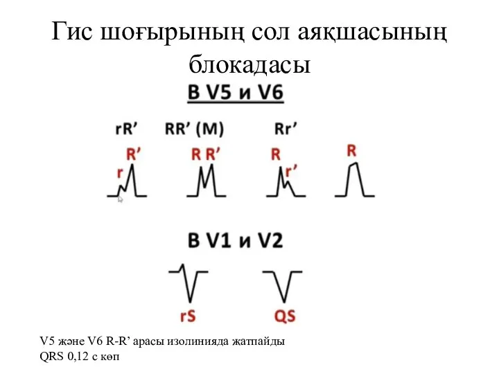 Гис шоғырының сол аяқшасының блокадасы V5 және V6 R-R’ арасы изолинияда жатпайды QRS 0,12 с көп