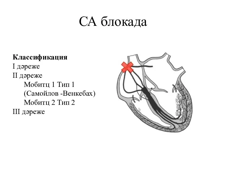 СА блокада Классификация I дәреже II дәреже Мобитц 1 Тип 1 (Самойлов