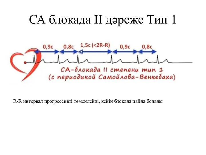 СА блокада II дәреже Тип 1 R-R интервал прогрессивті төмендейді, кейін блокада пайда болады