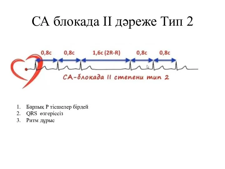 СА блокада II дәреже Тип 2 Барлық Р тісшелер бірдей QRS өзгеріссіз Ритм дұрыс