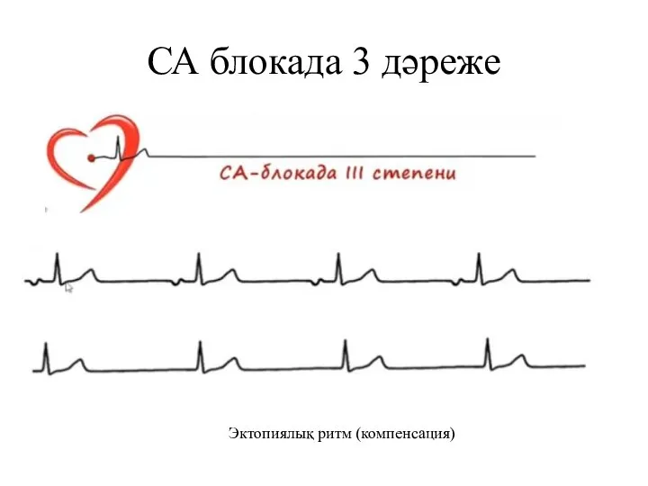 СА блокада 3 дәреже Эктопиялық ритм (компенсация)