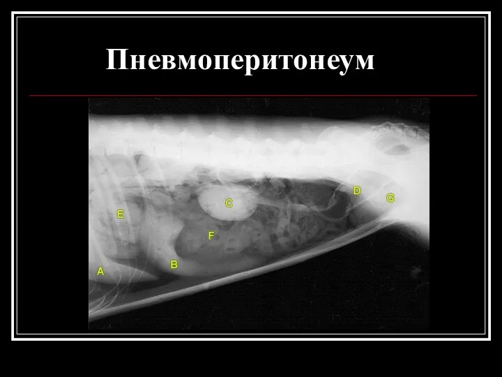 Пневмоперитонеум