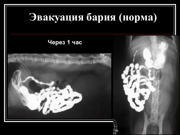 Эвакуация бария (норма) Через 1 час