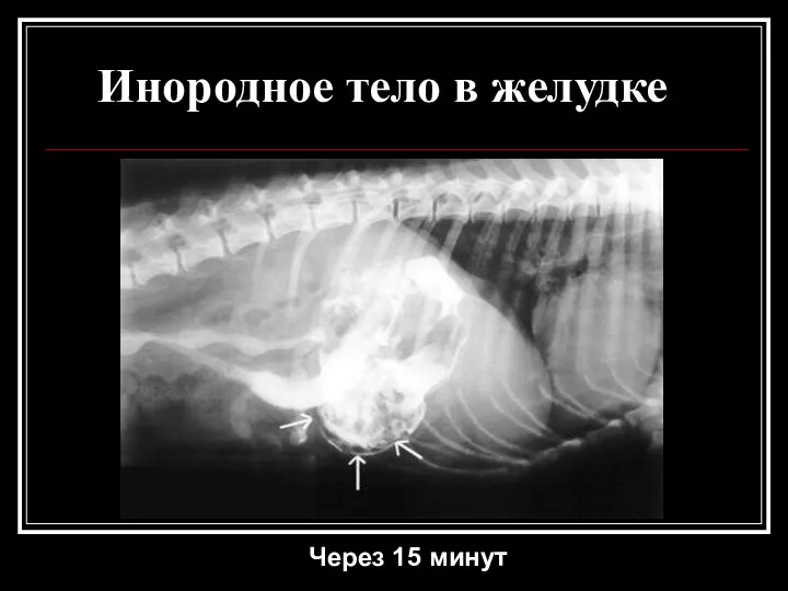 Инородное тело в желудке Через 15 минут