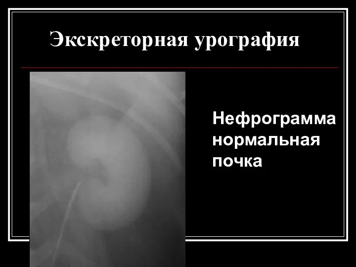 Экскреторная урография Нефрограмма нормальная почка