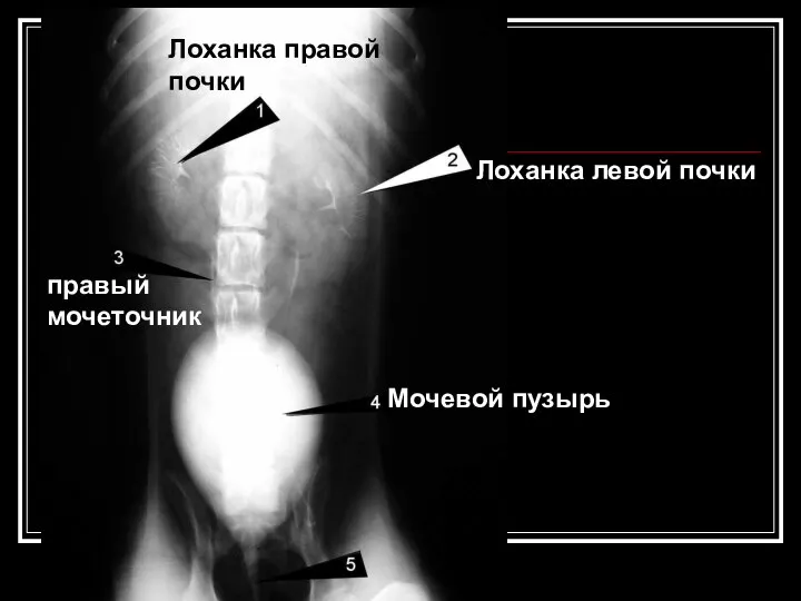 Лоханка левой почки Лоханка левой почки Лоханка правой почки Мочевой пузырь правый мочеточник