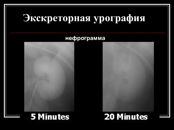 Экскреторная урография нефрограмма