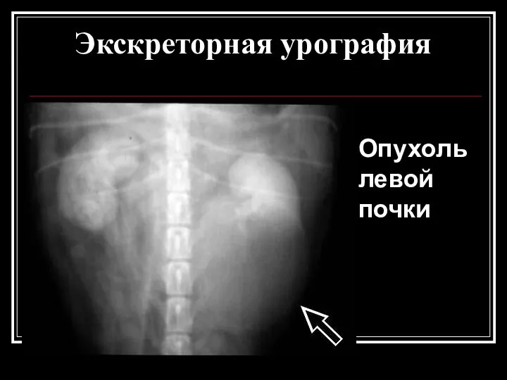 Экскреторная урография Опухоль левой почки