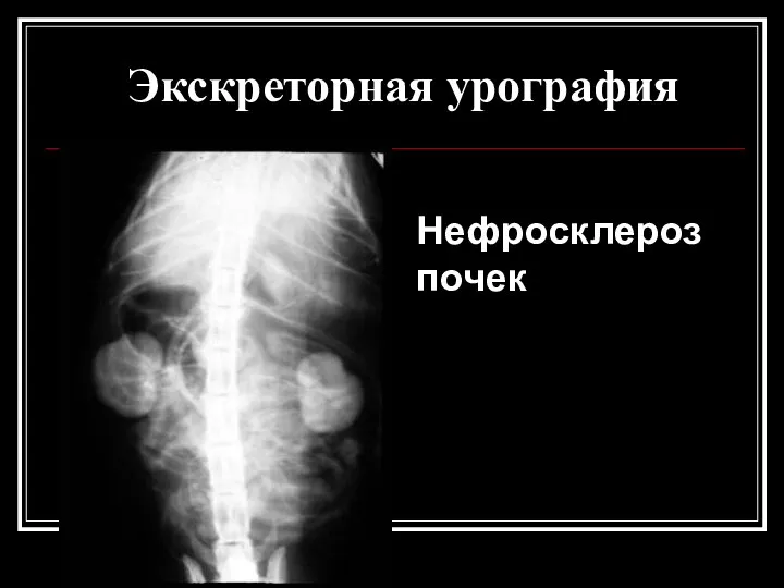 Экскреторная урография Нефросклероз почек