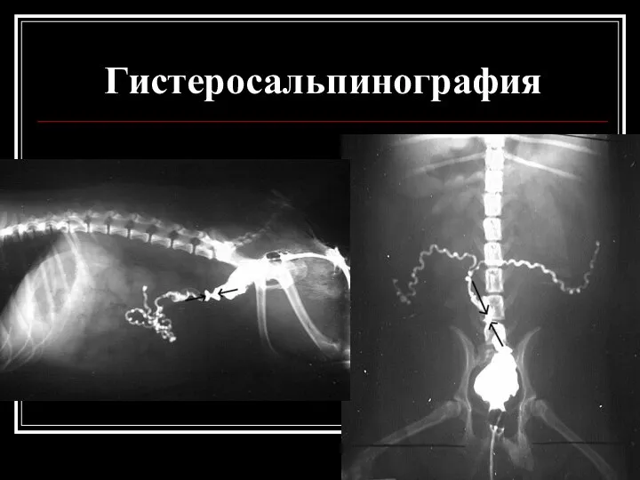 Гистеросальпинография