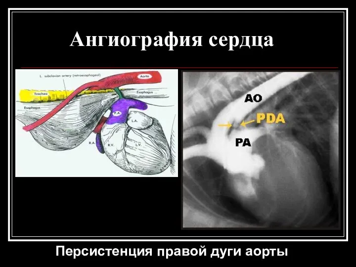 Ангиография сердца Персистенция правой дуги аорты