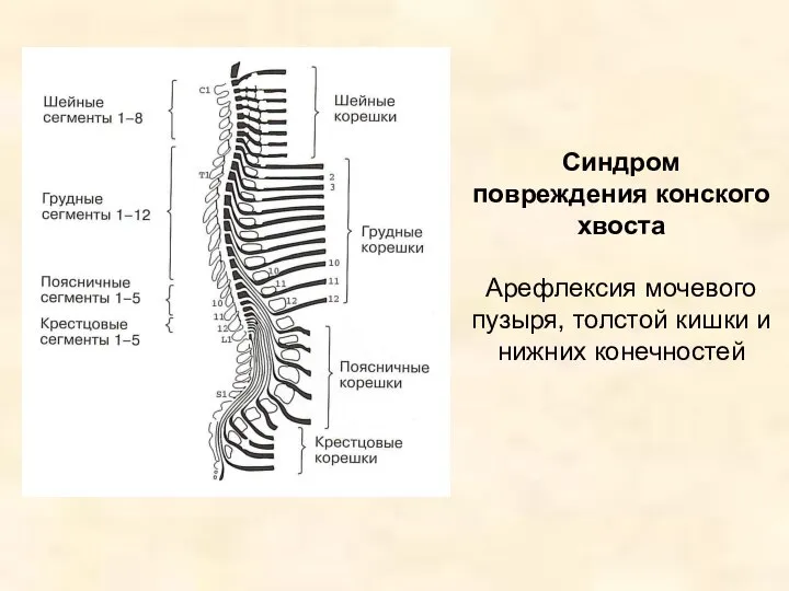 Синдром повреждения конского хвоста Арефлексия мочевого пузыря, толстой кишки и нижних конечностей