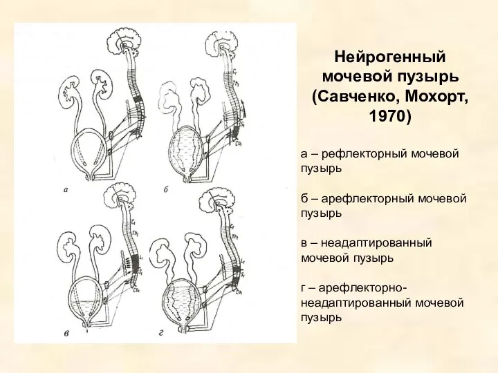 Нейрогенный мочевой пузырь (Савченко, Мохорт, 1970) а – рефлекторный мочевой пузырь б