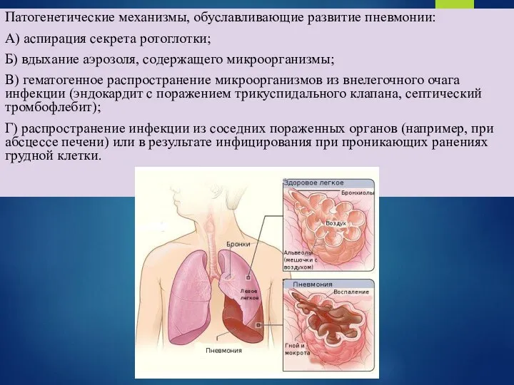 Патогенетические механизмы, обуславливающие развитие пневмонии: А) аспирация секрета ротоглотки; Б) вдыхание аэрозоля,