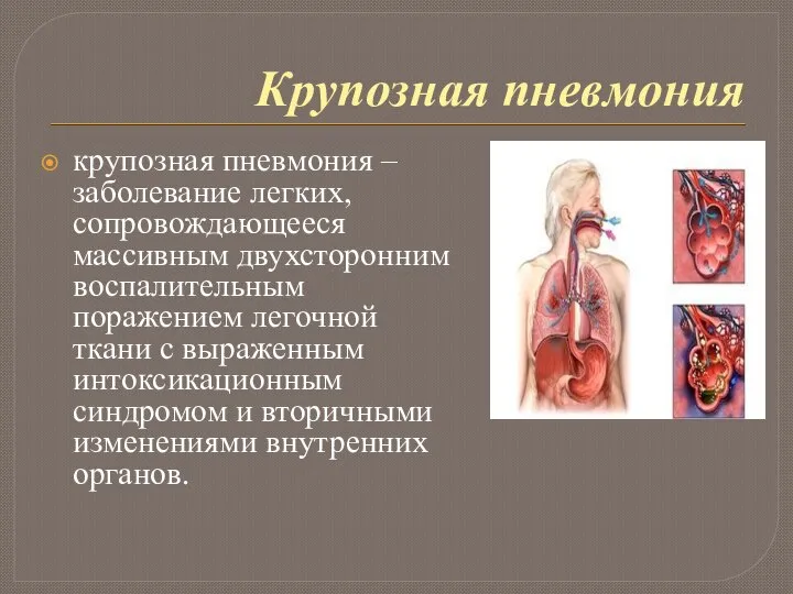 Крупозная пневмония крупозная пневмония – заболевание легких, сопровождающееся массивным двухсторонним воспалительным поражением