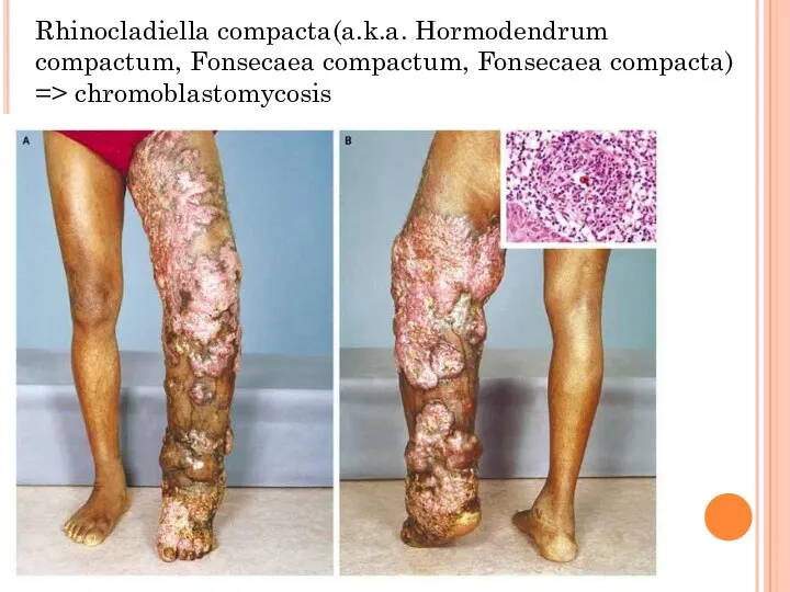 Rhinocladiella compacta(a.k.a. Hormodendrum compactum, Fonsecaea compactum, Fonsecaea compacta) => chromoblastomycosis