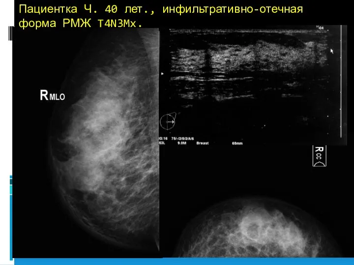 Пациентка Ч. 40 лет., инфильтративно-отечная форма РМЖ T4N3Mx.