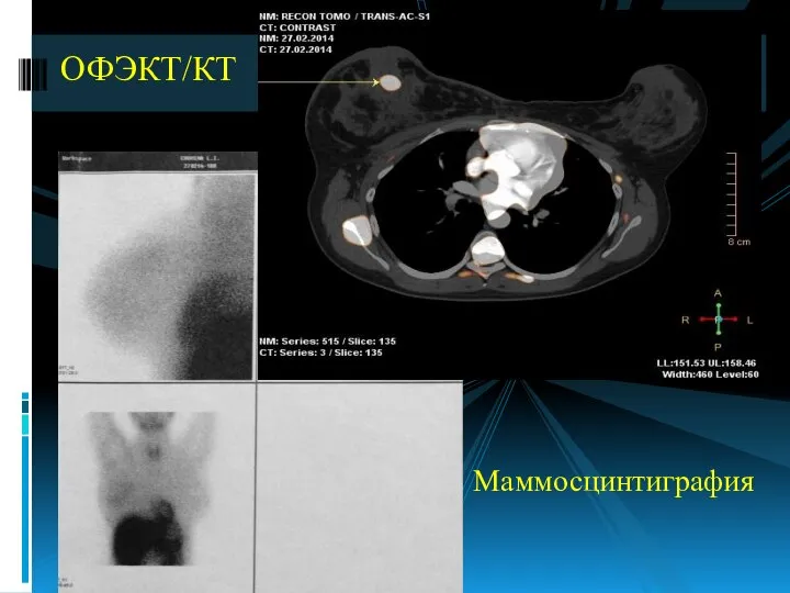 Маммосцинтиграфия ОФЭКТ/КТ