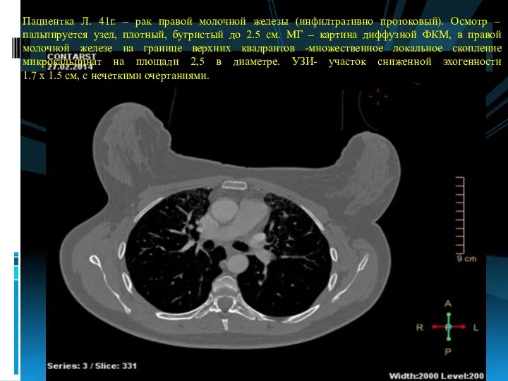 Пациентка Л. 41г. – рак правой молочной железы (инфилтративно протоковый). Осмотр –