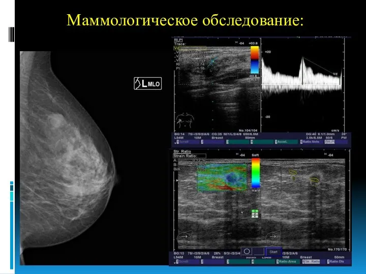 Маммологическое обследование: