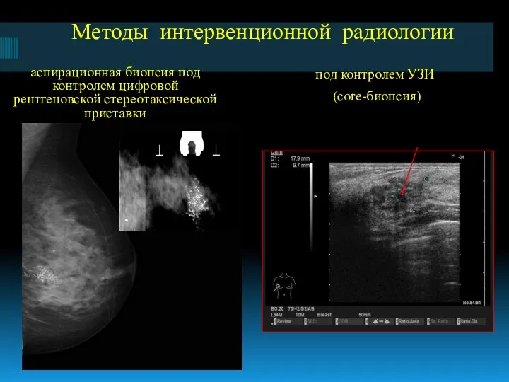 Методы интервенционной радиологии аспирационная биопсия под контролем цифровой рентгеновской стереотаксической приставки под контролем УЗИ (core-биопсия)