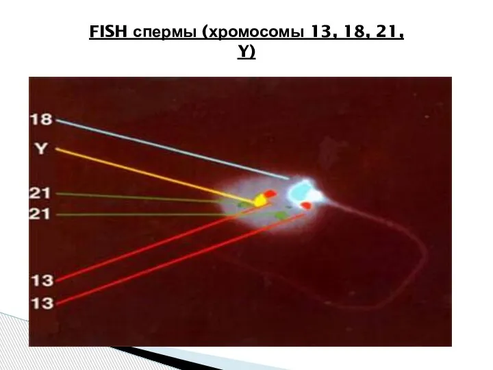 FISH спермы (хромосомы 13, 18, 21, Y)