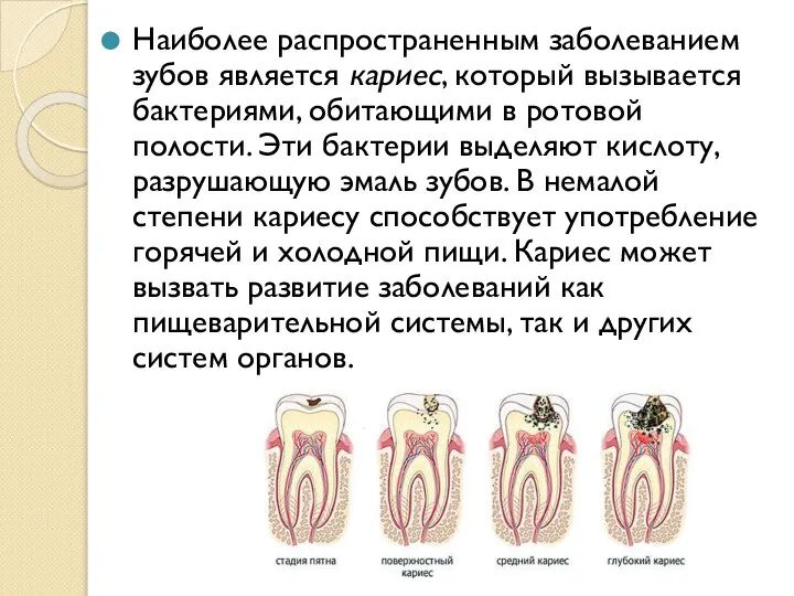 Наиболее распространенным заболеванием зубов является кариес, который вызывается бактериями, обитающими в ротовой