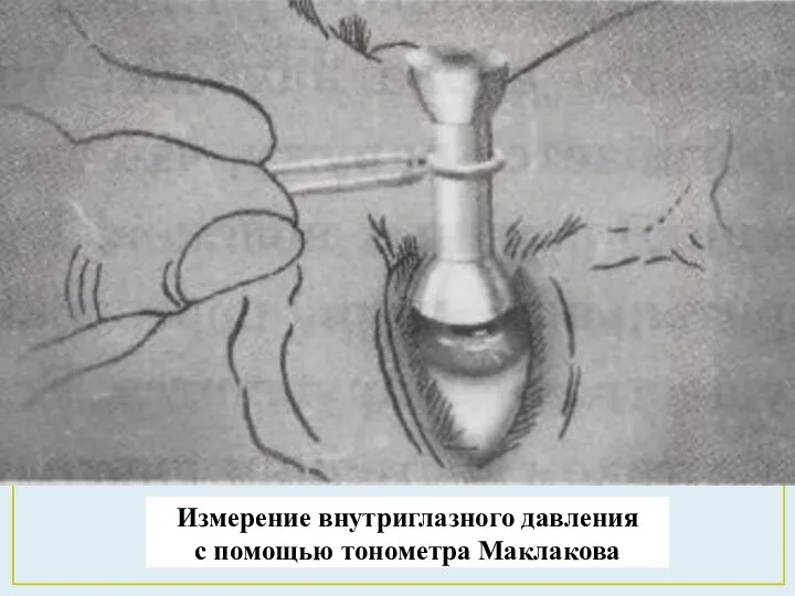 Измерение внутриглазного давления с помощью тонометра Маклакова