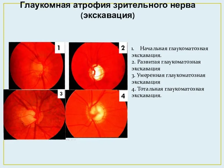 Глаукомная атрофия зрительного нерва (экскавация) Начальная глаукоматозная экскавация. 2. Развитая глаукоматозная экскавация