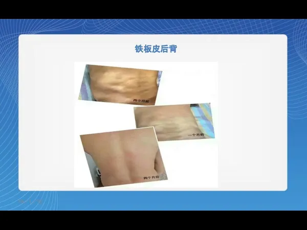 铁板皮后背 18／1／16