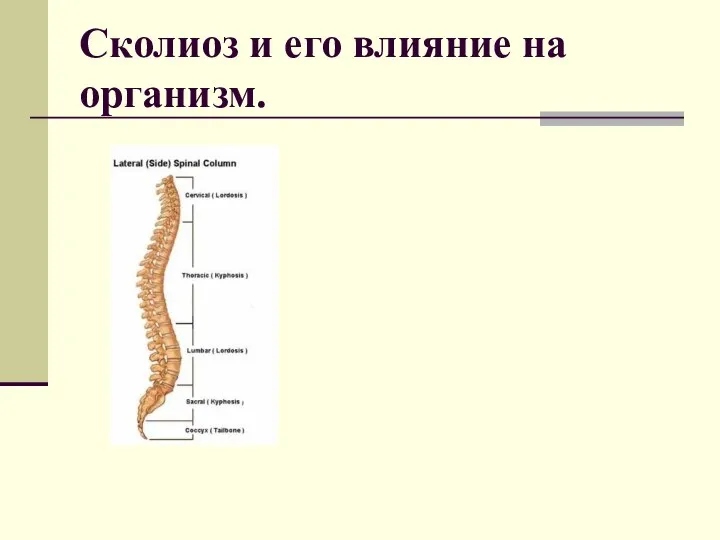 Сколиоз и его влияние на организм.