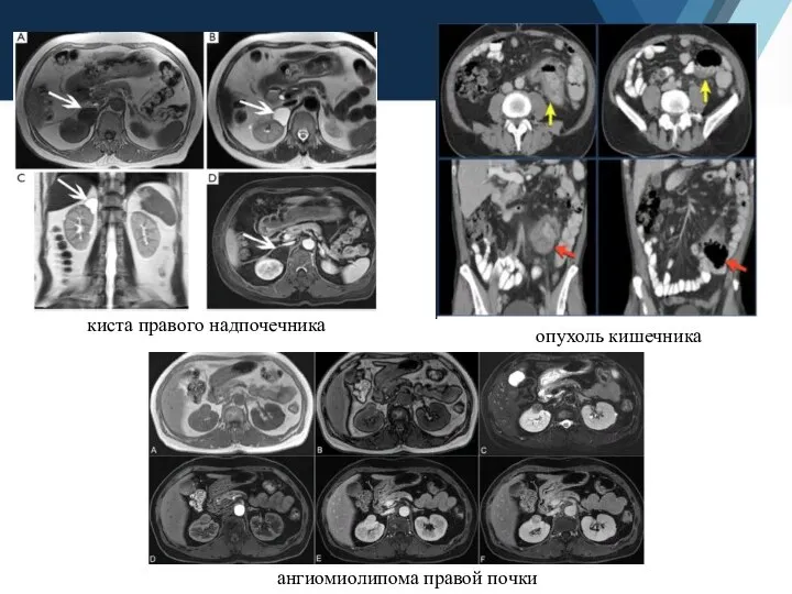 киста правого надпочечника ангиомиолипома правой почки опухоль кишечника