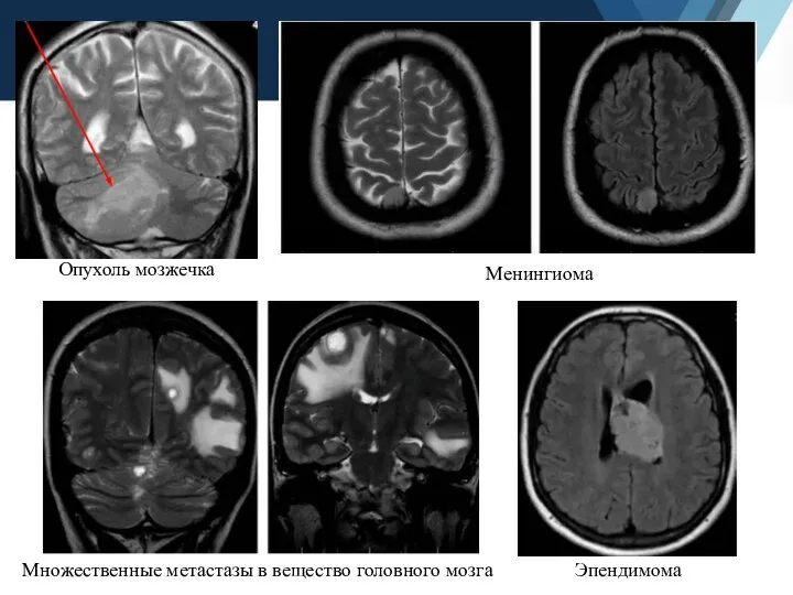Опухоль мозжечка Эпендимома Множественные метастазы в вещество головного мозга Менингиома