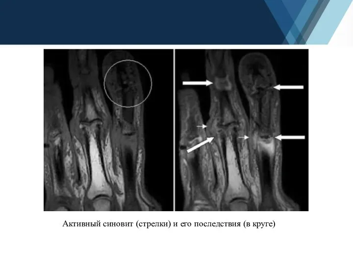 Активный синовит (стрелки) и его последствия (в круге)