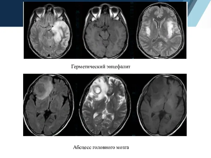 Герметический энцефалит Абсцесс головного мозга