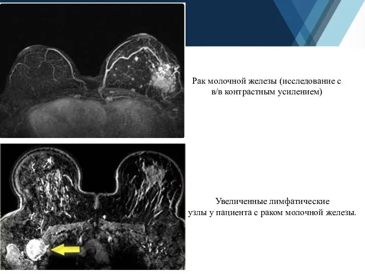 Рак молочной железы (исследование с в/в контрастным усилением) Увеличенные лимфатические узлы у
