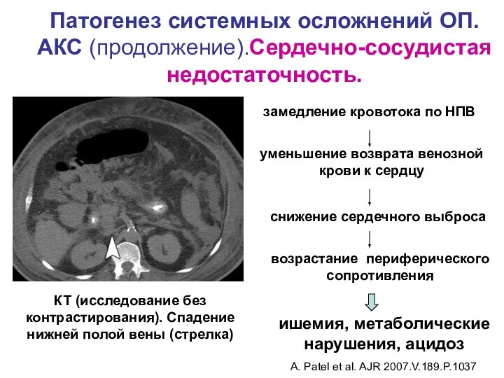 Патогенез системных осложнений ОП. АКС (продолжение).Сердечно-сосудистая недостаточность. КТ (исследование без контрастирования). Спадение