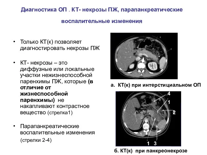 Диагностика ОП . КТ- некрозы ПЖ, парапанкреатические воспалительные изменения Только КТ(к) позволяет